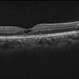 Macular Telangectasia Type 2 OCT OD Macular Telangectasia Type 2 OCT OD