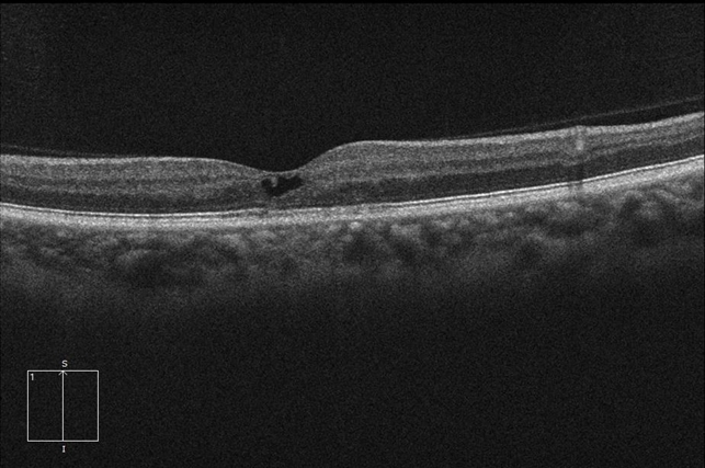 Macular telangectasia type 2 oct od Macular Telangectasia Type 2 OCT OD - Retina Image Bank