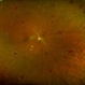 Roth Spots in Acute Myeloid Leukemia Roth Spots in Acute Myeloid Leukemia