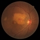 Choroidal Neovascularization in Patient With Choroidal Osteoma