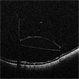 iOCT of Dislocated IOL iOCT of Dislocated IOL