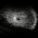 Superotemporal Branch Retinal Vein Occlusion