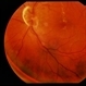 Vitreous Traction on Disc / PVD Vitreous Traction on Disc / PVD
