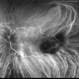 ICG: Choroidal Aspergilloma With Secondary Choroidal Neovascularization and Exudative Retinal Detachment ICG: Choroidal Aspergilloma With Secondary Choroidal Neovascularization and Exudative Retinal Detachment