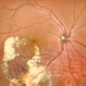 Leber's Miliary Aneurysm Leber's Miliary Aneurysm