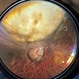 Fundal Coloboma Fundal Coloboma