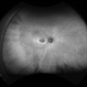 Hydroxychloroquine Maculopathy Hydroxychloroquine Maculopathy
