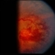 Retinal Capillary Hemangioblastoma Retinal Capillary Hemangioblastoma