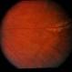 CGD / Chronic Granulomatous Disease
