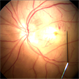 Retina