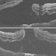 Macular Hole Retinal Detachment