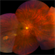 Torpedo Retinopathy