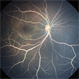 Lipemia Retinalis Lipemia Retinalis