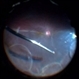 Old RRD With Retinal Cysts and High Watermark