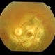 Traumatic Optic Neuropathy With Macular Scar