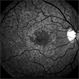 Reticular Drusen, Doyne's Honeycomb Retinal Dystrophy, Malattia Leventinese, Familial Dominant Drusen