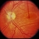 Pseudotumor Cerebri Pseudotumor Cerebri