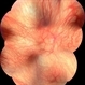 Oculocutaneous Albinism Fundus Photograph Oculocutaneous Albinism Fundus Photograph