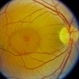 Central Serous Chorioretinopathy (CSR)