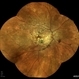 Idiopathic Multifocal Choroiditis Idiopathic Multifocal Choroiditis