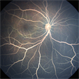 Lipemia Retinalis Lipemia Retinalis