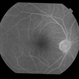 Adult Coats' Disease