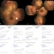 CSNB - Oguchi's Disease CSNB - Oguchi's Disease