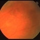 Operculated Retinal Tear Operculated Retinal Tear