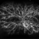 CRVO with Macular Edema. CRVO with Macular Edema.