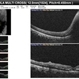 Idiopathic Intracranial Hypertension Idiopathic Intracranial Hypertension