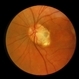 Optic Disc Pit Optic Disc Pit
