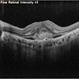 Subretinal Neovascular Membrane