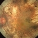 X-Linked Retinitis Pigmentosa X-Linked Retinitis Pigmentosa