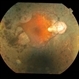 Gyrate Atrophy of Choroid and Retina