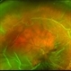 Total retinal Detachment multiple holes Total retinal Detachment multiple holes