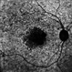 Stargardt's Disease Stargardt's Disease