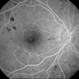Diabetic Retinopathy
