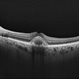Pattern Dystrophy Pattern Dystrophy
