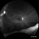 Telangiectasia 5 Telangiectasia 5
