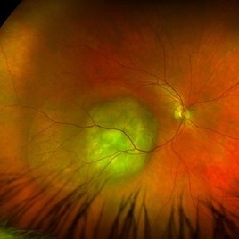 Choroidal Metastasis - Retina Image Bank