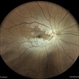 Central Retinal Artery Occlusion Central Retinal Artery Occlusion