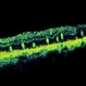 Retinal Folds Following Retinal Reattachment Surgery Retinal Folds Following Retinal Reattachment Surgery