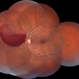 Subhyaloid Hemorrhage