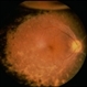 Necrotizing Retinitis Necrotizing Retinitis