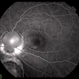 Colobomatous Optic Disc Maculopathy Colobomatous Optic Disc Maculopathy