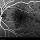 Persistent Placoid Maculopathy Persistent Placoid Maculopathy