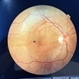 Parafoveal Telangiectasia