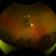 The Cliff Hanger-Subhyaloid Hemorrhage Over Macula in Proliferative  BRVO The Cliff Hanger-Subhyaloid Hemorrhage Over Macula in Proliferative  BRVO