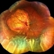 Choroidal Melanoma with Exudative Retinal Detachment Choroidal Melanoma with Exudative Retinal Detachment
