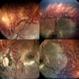 Retinal / RPE dysgenesis vs secondary atrophic changes Retinal / RPE dysgenesis vs secondary atrophic changes